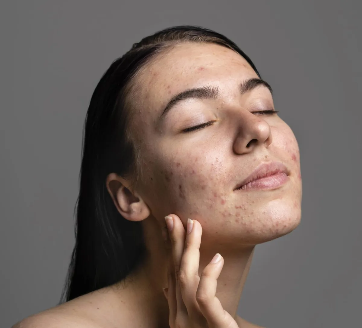 Acne Scar Solutions: How Brooklyn Clients Are Erasing Years of Damage in Weeks — Be You Esthetic Suites Brooklyn