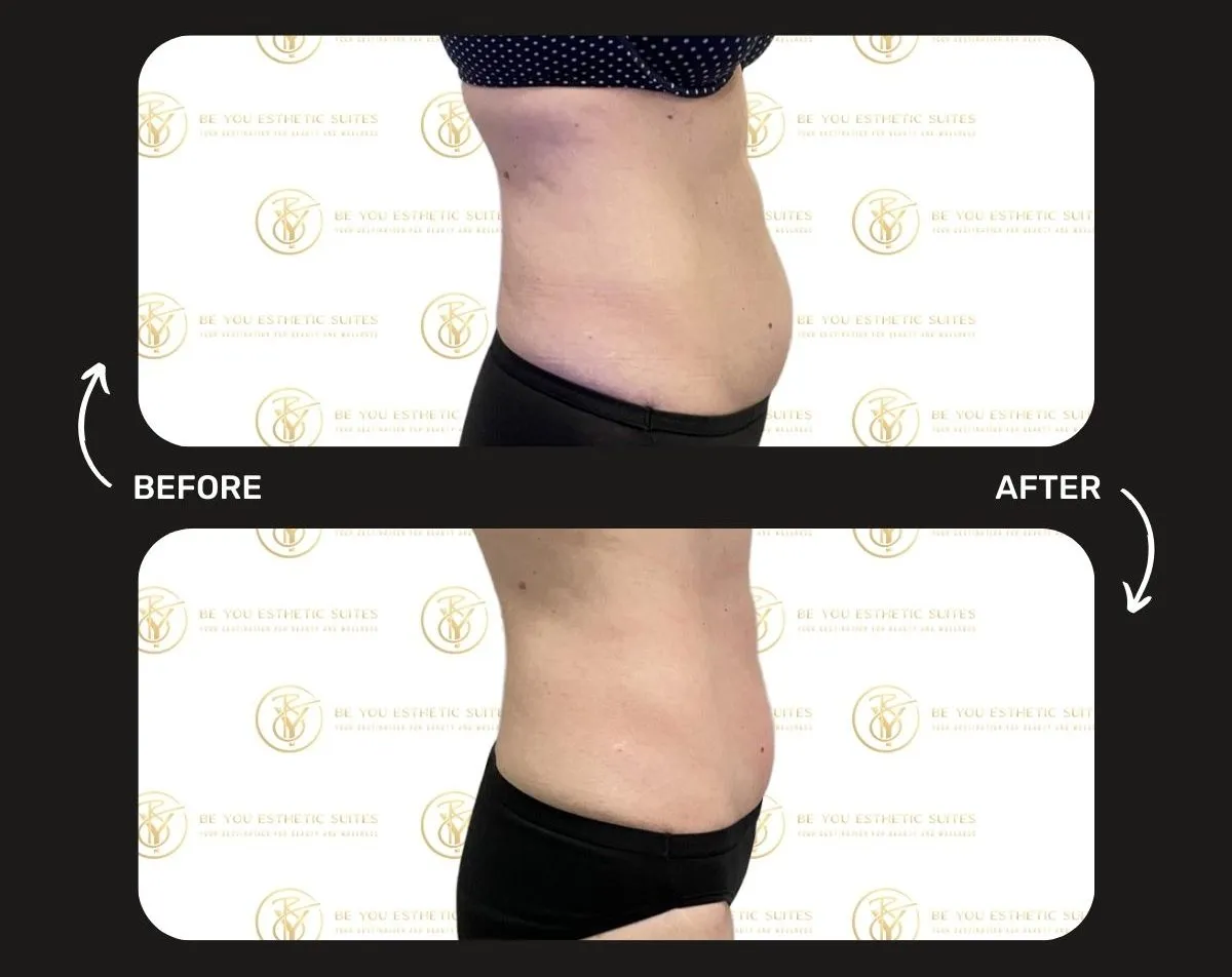 The Complete Guide to Body Contouring: Transforming Your Shape Without Surgery — Be You Esthetic Suites Brooklyn