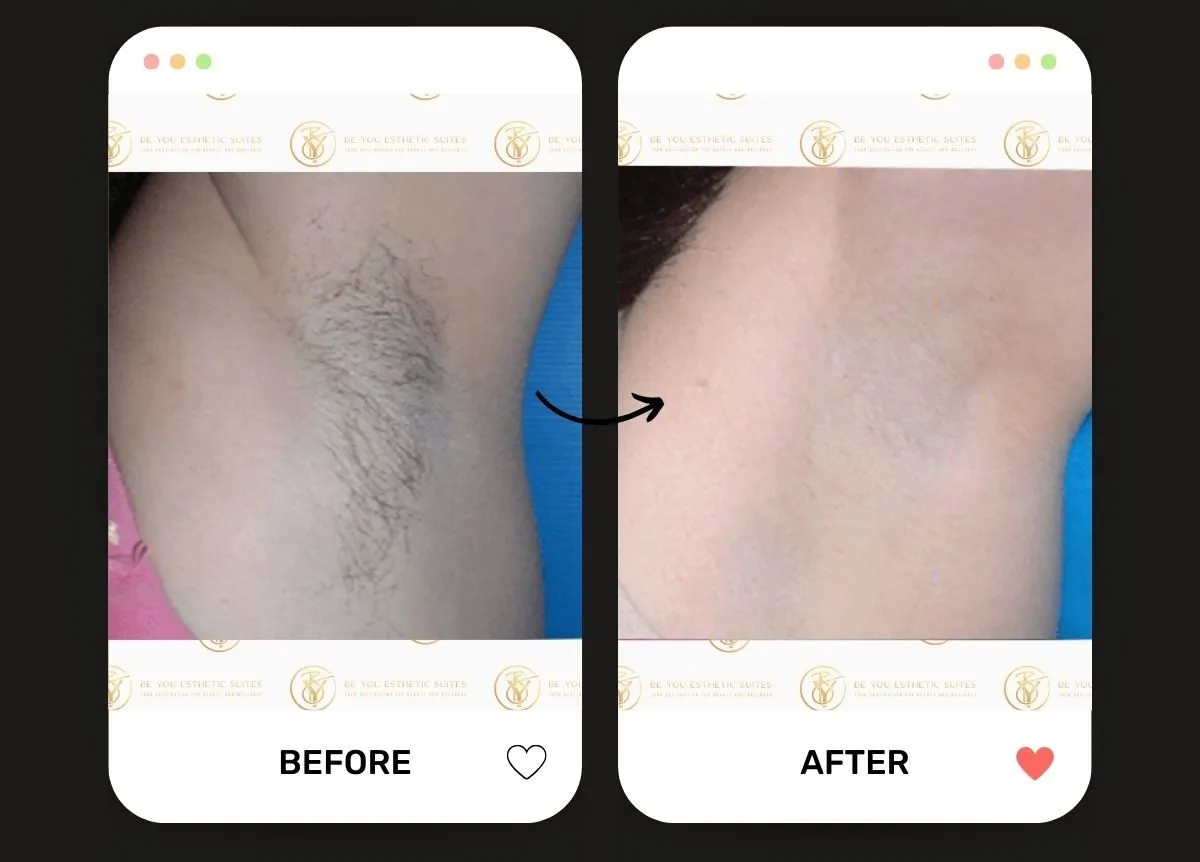 Laser Hair Removal in Brooklyn: Your Complete Guide to Permanent Hair Reduction — Be You Esthetic Suites Brooklyn