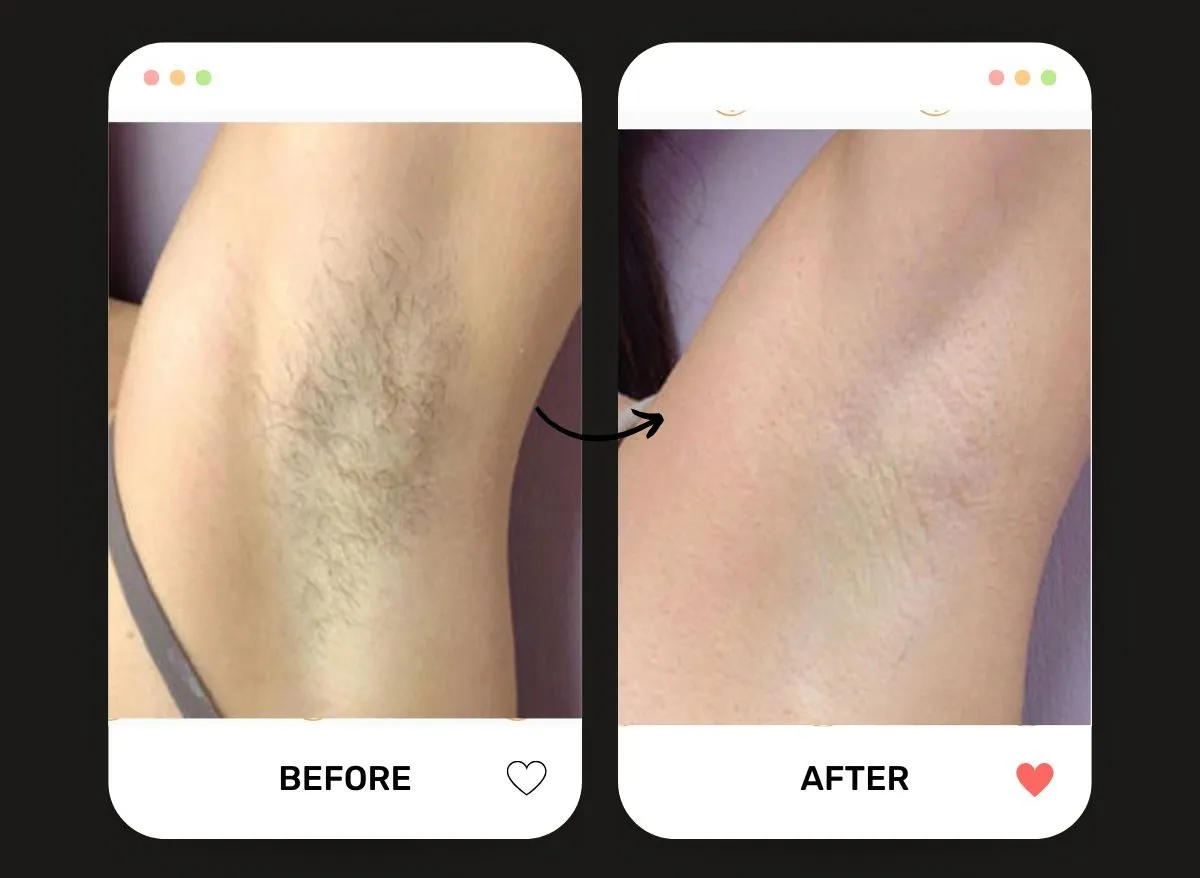 The Complete Guide to Laser Hair Removal: How Brooklyn’s Top Med Spa Delivers Smooth Results — Be You Esthetic Suites Brooklyn