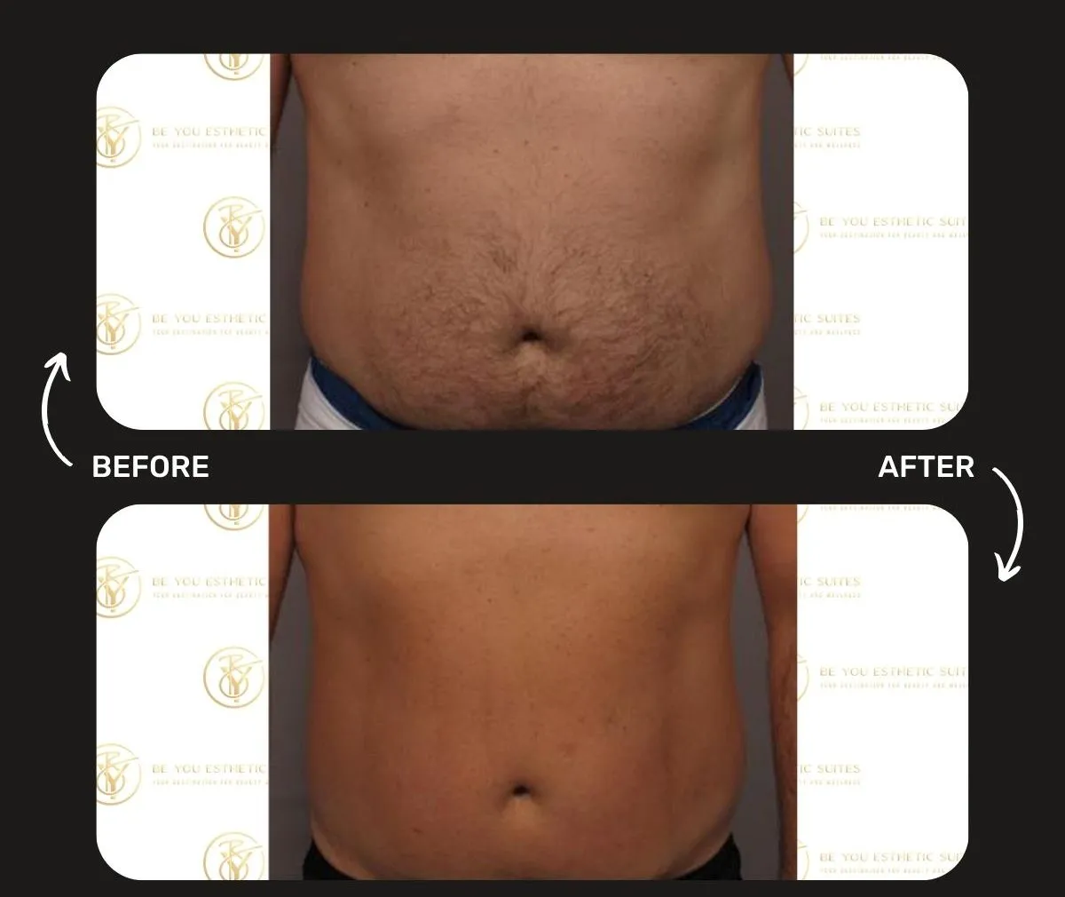 Preparing for Your Laser Hair Removal Journey: A Step-by-Step Guide from Brooklyn’s Favorite Med Spa — Be You Esthetic Suites Brooklyn