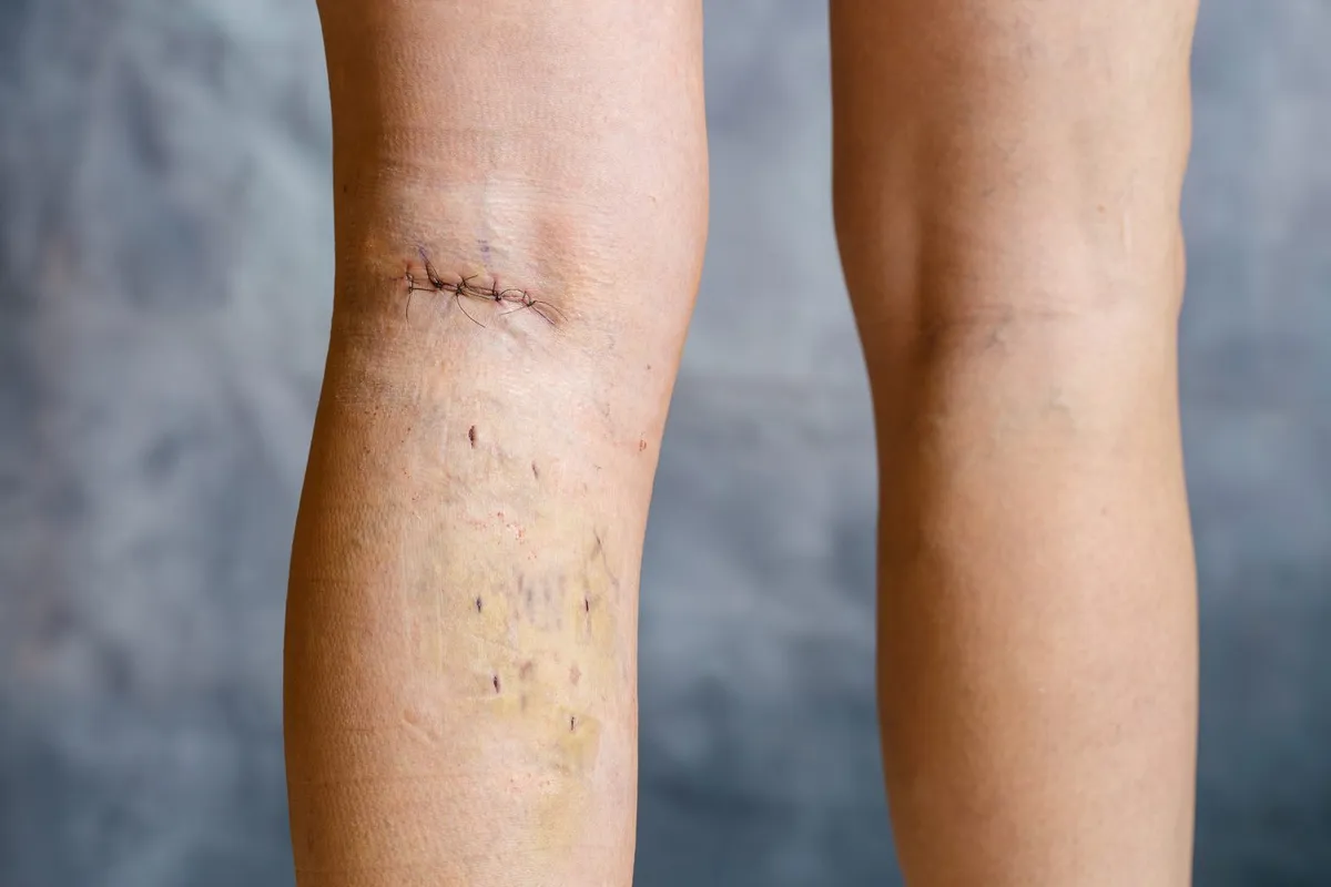 Managing Post-Surgery Swelling: Benefits of Medical-Grade Lymphatic Drainage in Brooklyn — Be You Esthetic Suites Brooklyn