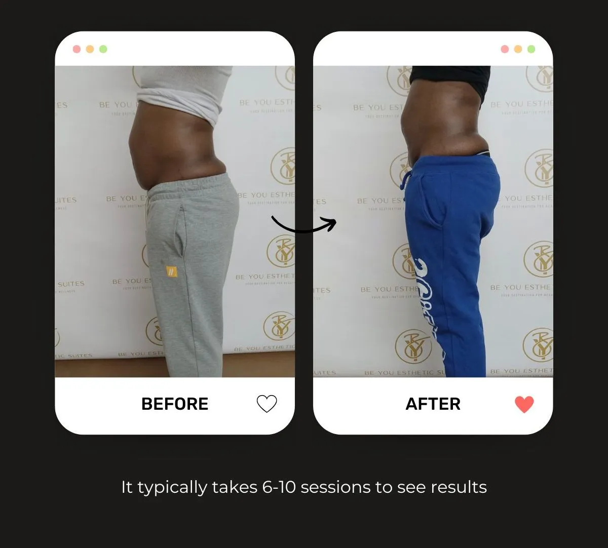 Ultrasonic Cavitation: The Non-Invasive Alternative to Post-Liposuction Touch-Ups — Be You Esthetic Suites Brooklyn