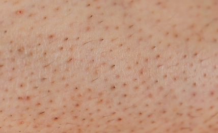 Are you tired of constant shaving, waxing, or dealing with ingrown hairs