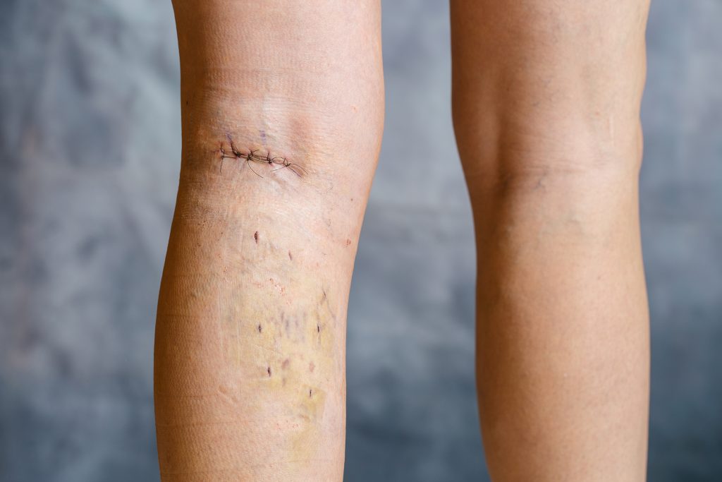 Be You Esthetic Suites is a med spa specializing in post-surgery care and post-surgery swelling treatments like a professional lymphatic drainage massage in Brooklyn