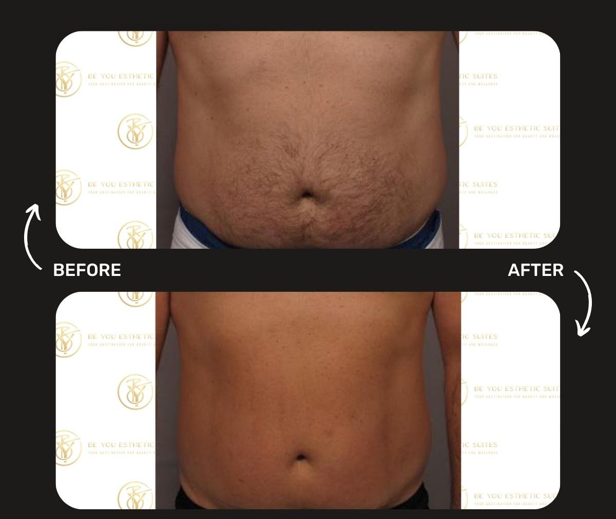 Learn about laser hair removal preparation with these pre-treatment care and post-treatment tips to give you optimal results. Laser hair removal is offered at Be You Esthetic Suites, brooklyns premier med spa offering a wide range of services at an affordable price. body sculpting, botox, chemical peel, facials, glp-1, lip fillers, lymphatic drainage massage med spa, red light therapy, semaglutide