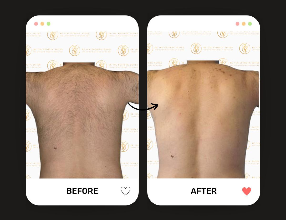 Understand the laser hair removal comparison to waxing alternatives. See how laser hair removal is the pain-free options with better long-term savings. Contact Be You Esthetic Suites in Brooklyn for a session for an affordable price. med spa, body sculpting, botox, chemical peel, facials, glp-1, lip fillers, lymphatic drainage massage, red light therapy, semaglutide