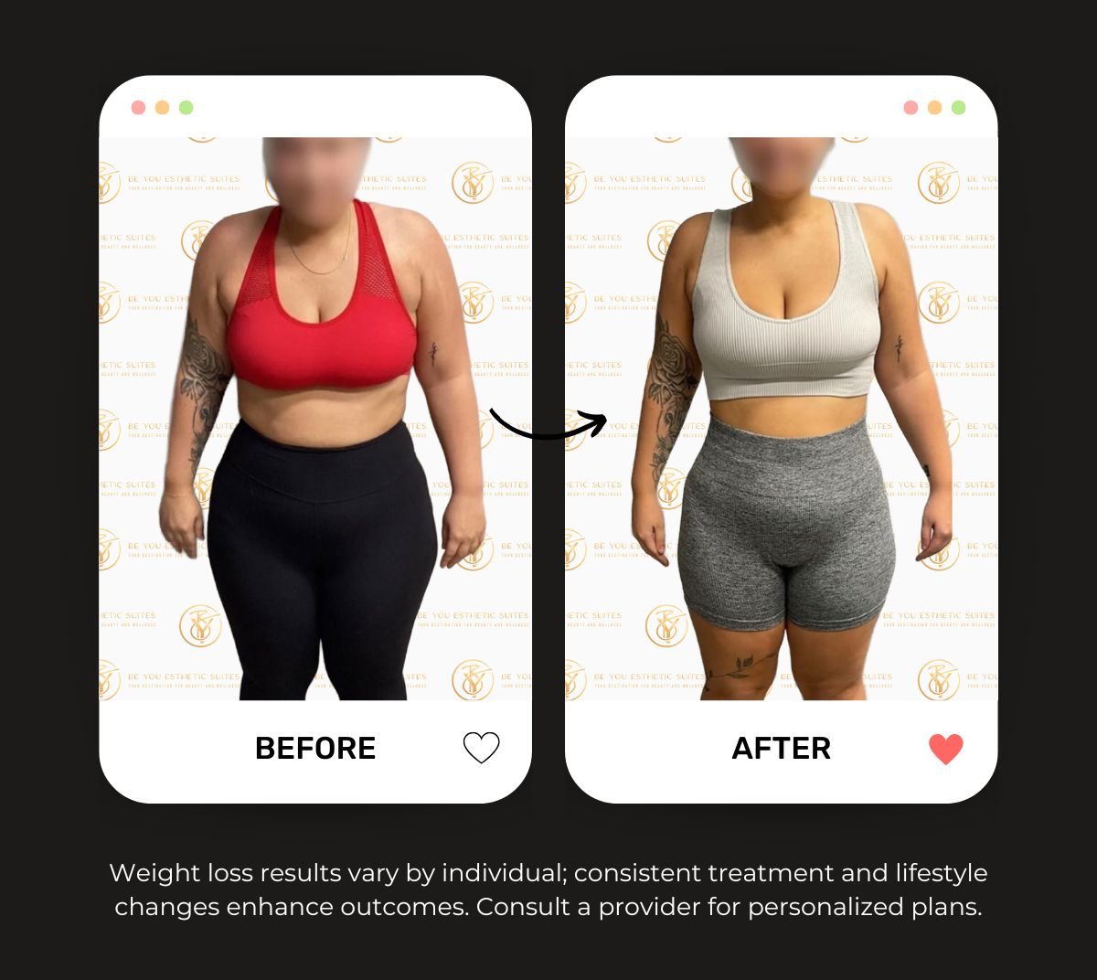 Experience Be You Esthetic Suites Tirzepatide Treatment as an effective weight loss solution. Explore how Tirzepatide can help manage appetite regulation and metabolic health. Explore the other weight loss options Be You Esthetic Suites offers in brooklyn. Body sculpting, botox, chemical peel, facials, glp-1, laser hair removal lip fillers, lymphatic drainage massage, med spa, red light therapy, semaglutide
