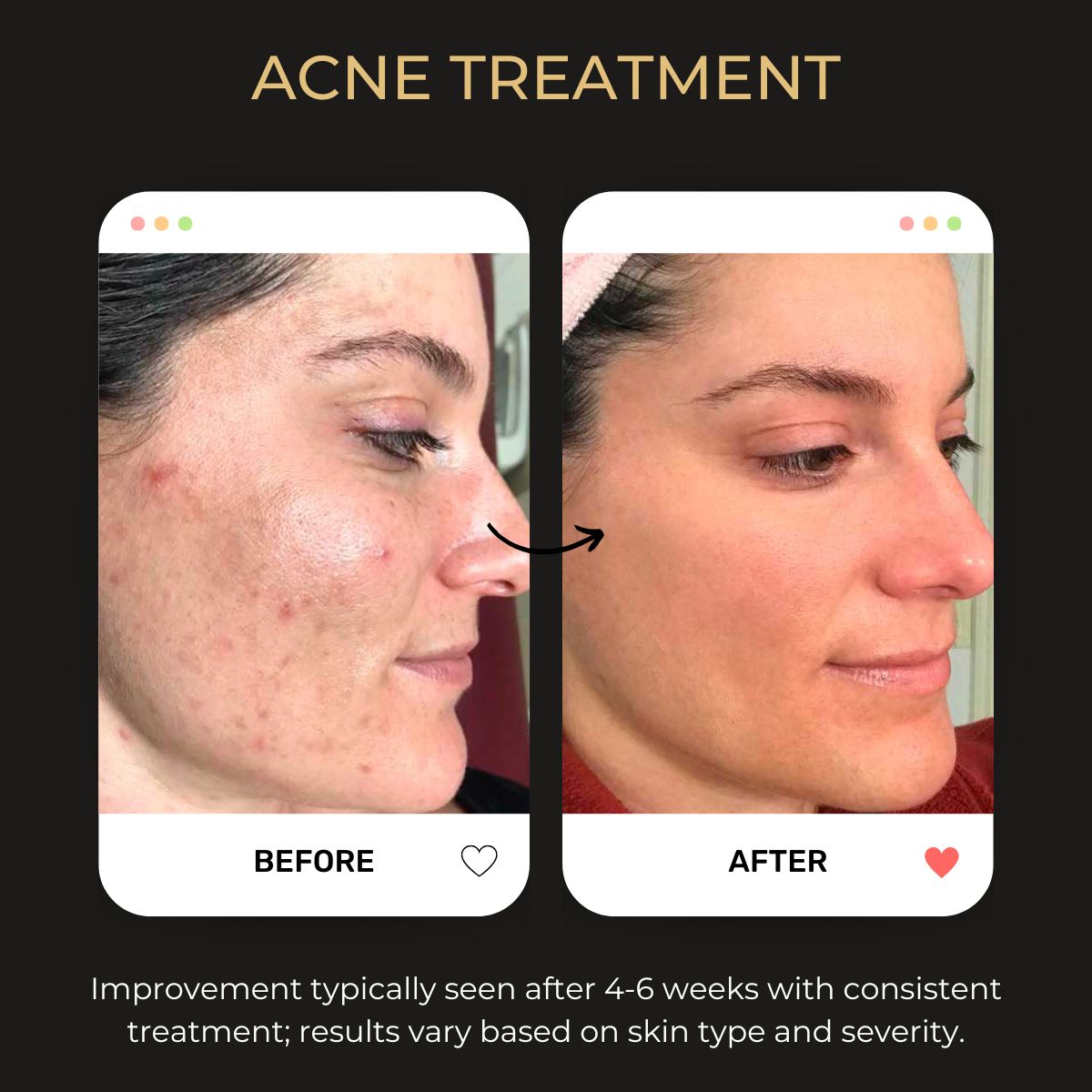 Brooklyn face treatments, treatment session targeting skin texture and hyperpigmentation using professional exfoliation methods.