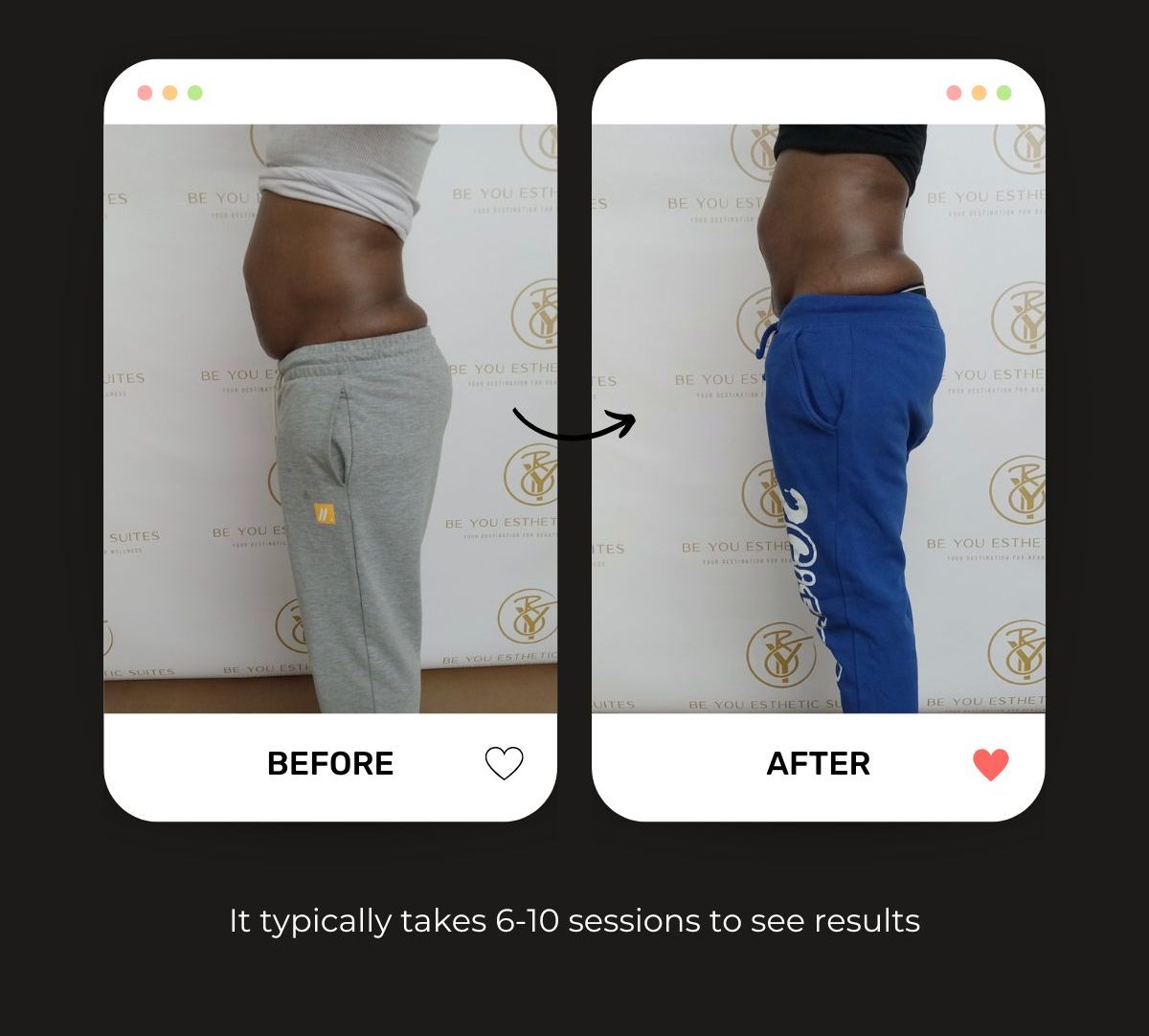 Explore how Ultrasonic Cavitation is the best liposuction alternative in Brooklyn, NY. This treatment requires no recovery period for clients. Be You Esthetic Suites is the top rated med spa in Brooklyn. Offering facials in Brooklyn, Brooklyn body sculpting, Ultrasonic cavitation in Brooklyn, Brooklyn Med spa, red light therapy treatments in Brooklyn, massages in Brooklyn.