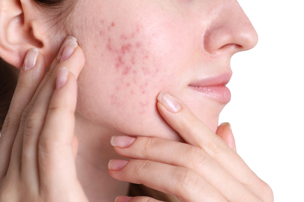 Be You Esthetic Suites is the top rated med spa suites in Brooklyn, offering affordable med spa services in Brooklyn from independent service providers. Post surgery healing services like lymphatic drainage massage near Park Slope, red light therapy in Brooklyn, and more to help you recover from your surgery quickly. They do also offer Brooklyn body sculpting treatments like ultrasonic cavitation in Brooklyn, wood therapy massage near Park Slope, and weight loss treatments in Brooklyn like Semaglutide and Tirzepatide. chemical peels in Brooklyn, acne treatments in Brooklyn, microdermabrasion near Park Slope, laser hair removal in Brooklyn, Brooklyn lip fillers, body fillers in Brooklyn, Brooklyn laser hair removal, laser hair near Park slope, microneedling in brooklyn, waxing in brooklyn. Microneedling active acne, acne treatment, inflamed skin